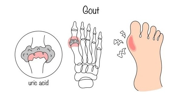 Khuyến cáo của bác sĩ trước tình trạng nhiều người trẻ đau nhức xương khớp do bệnh gout