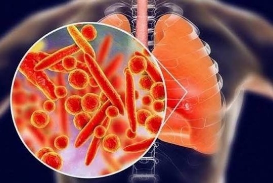 Bộ Y tế khuyến cáo người dân trước thông tin ca tử vong do viêm phổi tại Nga